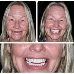 【Official Brand CustomFit Functional Dentures — Combination pack - Image 3