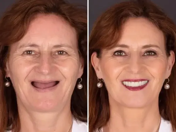 SmileFitPro BioFusion Dentures - Image 9