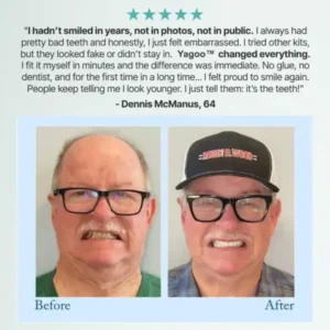 🦷Advanced Customized Full Denture Set🦷 (🔥10,000+ Sold In Last 30 Day) - Image 8