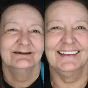 Alternative view of -Custom-Fit Functional Dentures