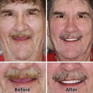 -Custom-Fit Functional Dentures - Image 4