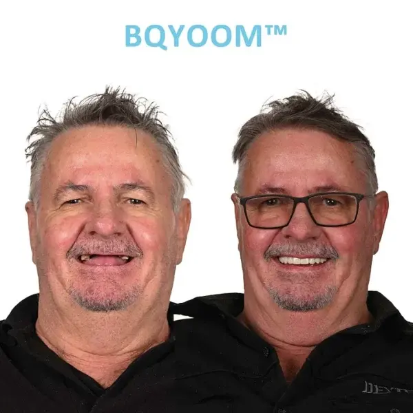 GelFit Dentures - Image 4