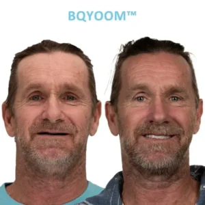 GelFit Dentures - Image 3