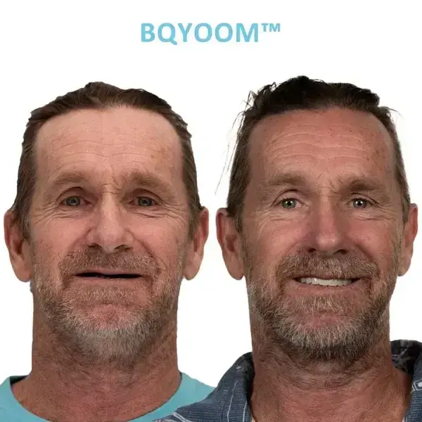 GelFit Dentures - Image 4