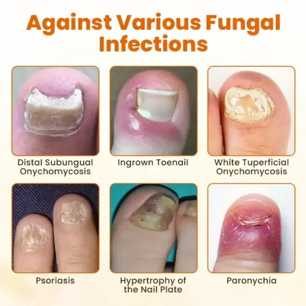 FungiFix Bee Venom Nail Spray - Image 7