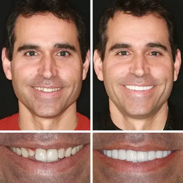 Custom-Fit Dentures - Image 8