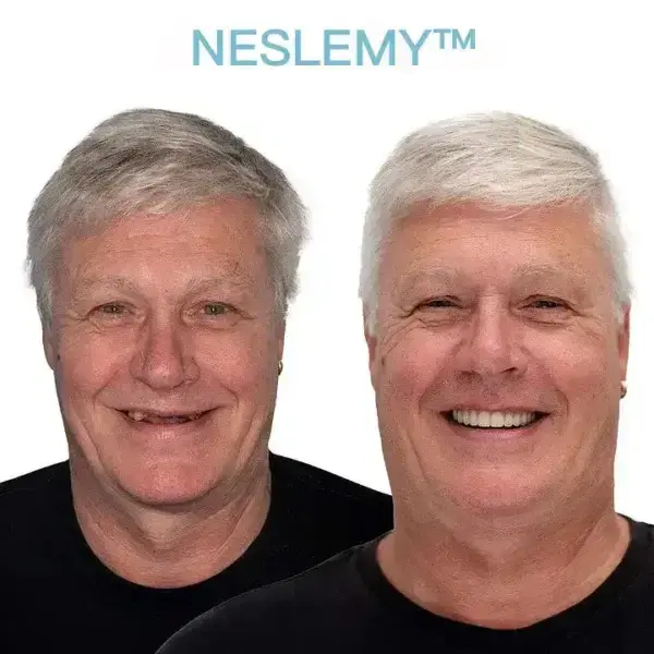 GelFit Dentures - Image 4