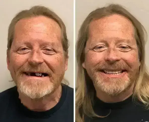 SmileFitPro BioFusion Dentures - Image 10