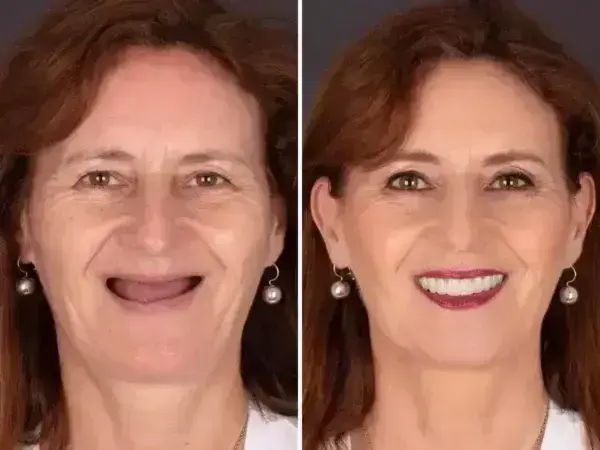 SmileFitPro BioFusion Dentures - Image 9