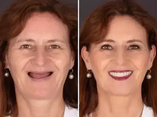 SmileFitPro BioFusion Dentures - Image 9