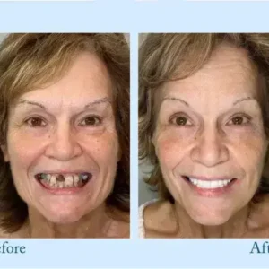 Dentures - Image 16