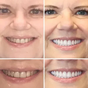 🌟 – Custom-Crafted Dentures That Feel as Natural as They Look👩‍🔬 - Image 9
