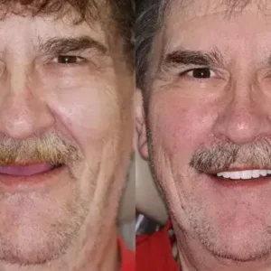 PREMIUM DENTURES - Image 11
