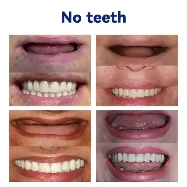 Vaxflite Full Denture Set (Top & Bottom) - Custom Fit Oral Prosthetic - Image 9