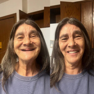 DentoFuse Dentures