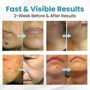 Non-Invasive Mole and Wart Removal Laser Pen - Image 11