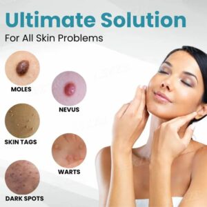 Non-Invasive Mole and Wart Removal Laser Pen - Image 6