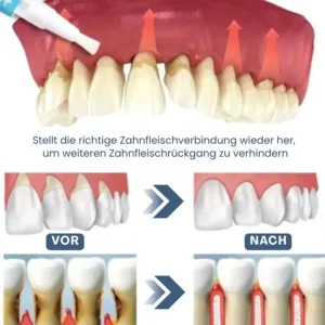 Zahnfleisch Sofort-Gel - Image 2