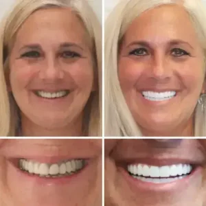 Advanced Customized Full Denture Set - Image 2