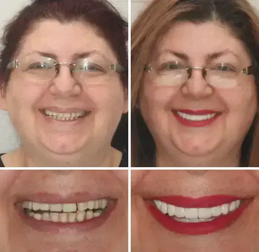 Advanced Customized Full Denture Set - Image 4
