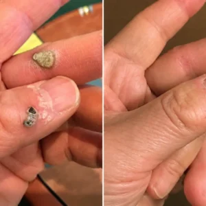 2-in-1 Microneedle & Hydrocolloid Patch - Image 6