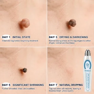 7-𝐷𝑎𝑦 𝗧𝐚𝐠 & 𝗦𝗽𝐨𝐭 𝐄𝐫𝒂𝒔𝒆𝒓(Zero Pain, Zero 𝐒𝐜𝐚𝒓𝒔 Rollerball) - Image 4