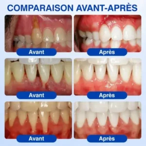 Gel Régénération Parodontale - Image 11