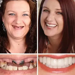 Functional Dentures - Image 13